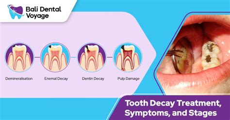 Tooth Decay Symptoms, Stages, and the Treatment