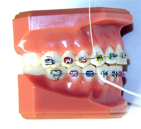 How to Brush and Floss with Braces – Your Smiling Faces.com