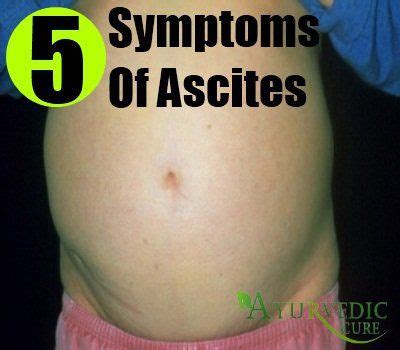 Various Common Signs And Symptoms Of Ascites | AyurvedicCure.com ...