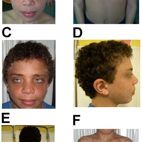 (PDF) LEOPARD syndrome: Clinical dilemmas in differential diagnosis of RASopathies