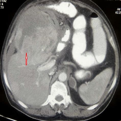 CT abdomen (axial view) displaying a large heterogenous partly ...