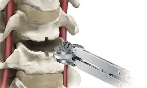 Cervical Disc Replacement | Spine Surgery Institute