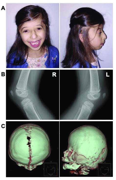 Gorlin Syndrome Symptoms