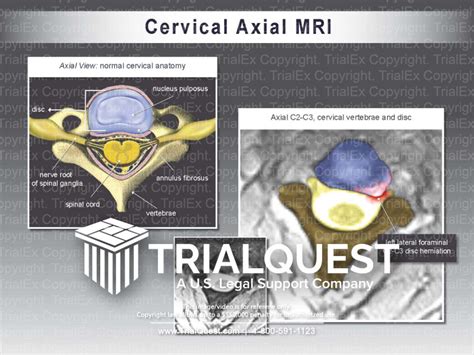 Normal Cervical Mri Axial