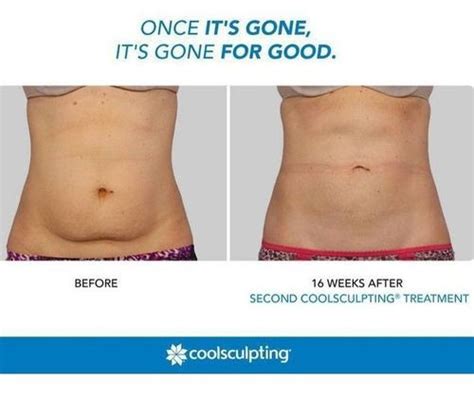 What Is Coolsculpting - Risks, Benefits And Side Effects (2022) | Fabbon