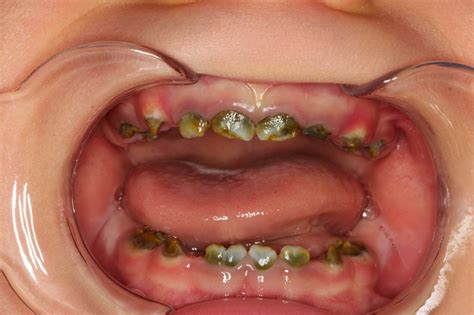 Green Teeth? The Many Shades of Congenital Syphilis - Oral Health Group