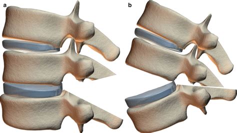 Pedicle Subtraction Osteotomy | Neupsy Key