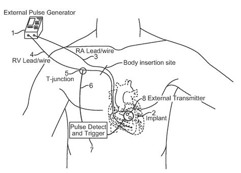 Transvenous Pacemaker Placement