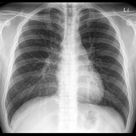 chest xray normal | Normal chest x-rays | Image | Radiopaedia.org | X ray, Radiology, Chest