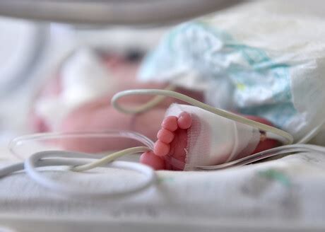 Delayed cord clamping in preterm babies reduces death risk by half