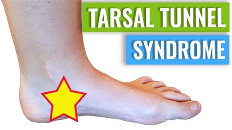 Tarsal Tunnel Syndrome Treatment & Diagnosis - YouTube