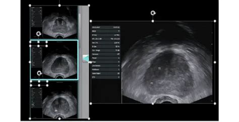 Transrectal Ultrasound: Everything You Need to Know | Healthtian