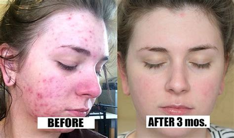 27 Life-Changing Products That Really Helped People With Acne | Bad acne, Acne treatment ...