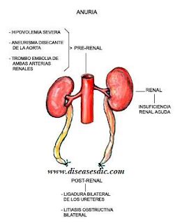 Anuria - Definitions, Causes, Symptoms, Treatment - The Thesis