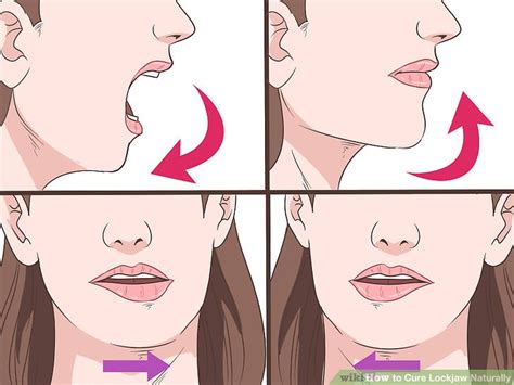 3 Easy Ways to Cure Lockjaw Naturally - wikiHow