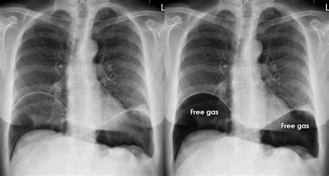 Abdominal X-ray - Abnormalities - Perforation - Erect Chest X-ray