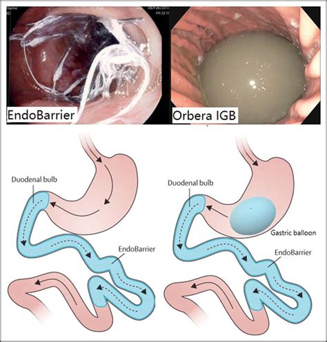 Visual demonstration of EndoBarrier and Orbera intragastric balloon... | Download Scientific Diagram