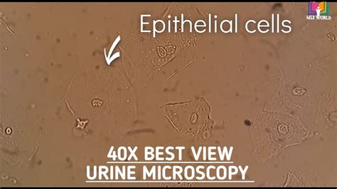 Epithelial cells seen in urine microscopy showing urinary tract ...