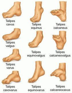 Congenital Talipes Equinovarus (Clubfoot) Nursing Care Management | Medical anatomy, Pediatric ...