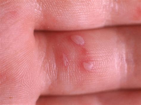 Childhood rashes, skin conditions and infections: photos - BabyCentre