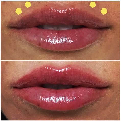 Botox lip flip | Albany Laser & Cosmetic Medical Spa in Edmonton Edmonton