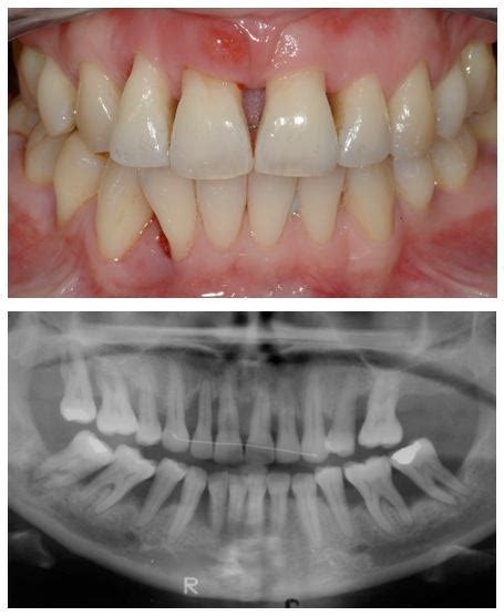 Bone Loss in Teeth Treatment | Advanced Dentistry