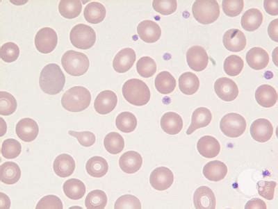 Teardrop cells (dacrocytes)