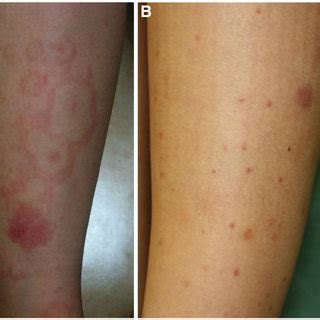 The cutaneous manifestations of Henoch-Schönlein purpura in our... | Download Scientific Diagram