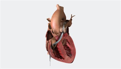 Impella RP® with SmartAssist® Pump in Heart Illustration | Abiomed.com