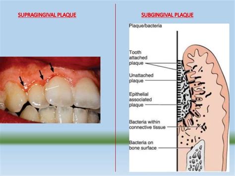 Dental plaque