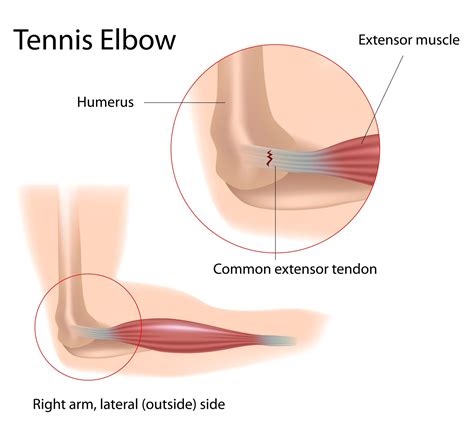 Tennis Elbow - Definition, Anatomy and Causes - Jeffrey H. Berg, M.D.