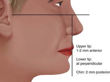 25 Maxillary Arch Implant Considerations | Upper lip, Implants, Lower lip