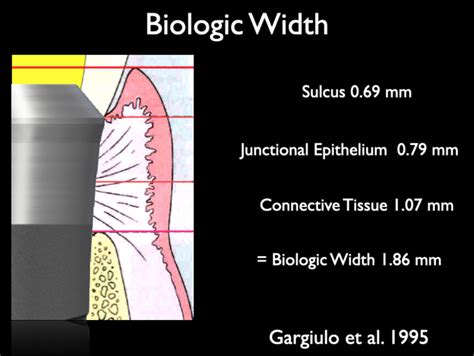 Biological Width Around Implant