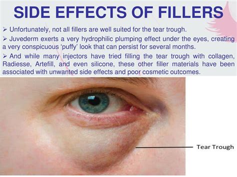 Fillers side effect - xolerskins