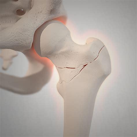 Bone Fracture Types and Symptoms | Globus Medical