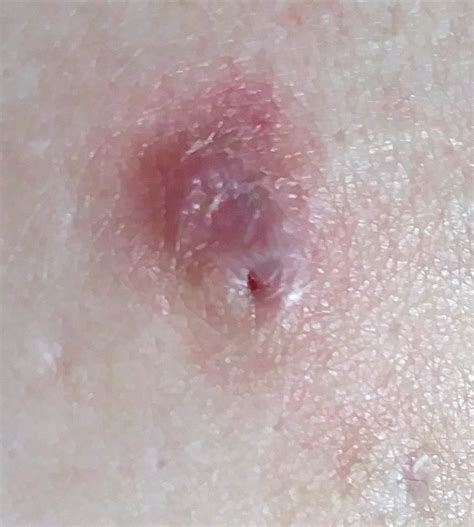 Skin Cancer Lesions On Chest