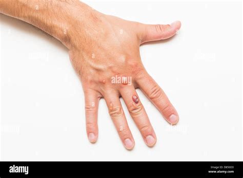 Man's hand covered with blisters caused by cryosurgery - wart removal procedure using liquid ...