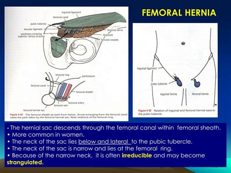 Femoral Hernia Female Images