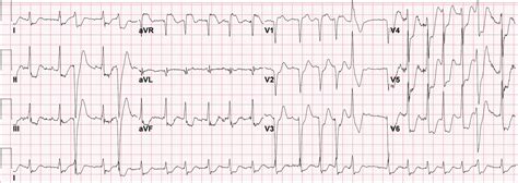 Dr. Smith's ECG Blog: ST-Elevation in aVR with diffuse ST-Depression: An ECG pattern that you ...