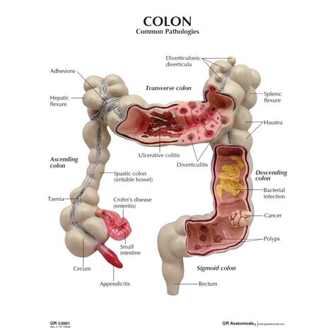 GPI 3340 Colon Model