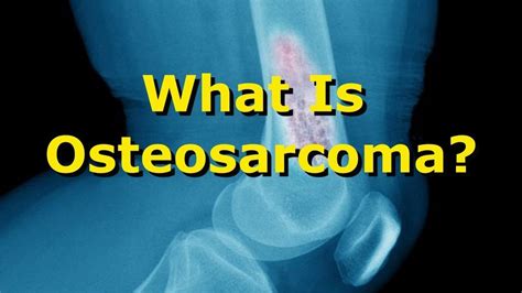 What Is Osteosarcoma? Osteogenic Sarcoma Symptoms - YouTube