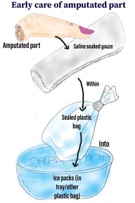 Replantation - Procedure & Outcome, Dr.Aashish Sasidharan