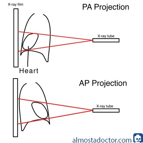 Chest X-Ray - almostadoctor