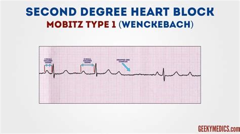 Atrioventricular Block | Heart Block | Geeky Medics