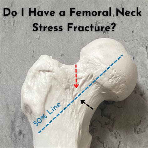 Do I Have a Femoral Neck Stress Fracture? | RunningMateKC