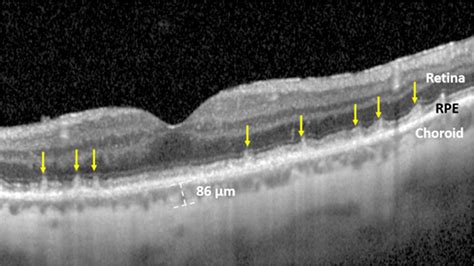 Age-Related Macular Degeneration Linked to Severe Vascular Disease ...