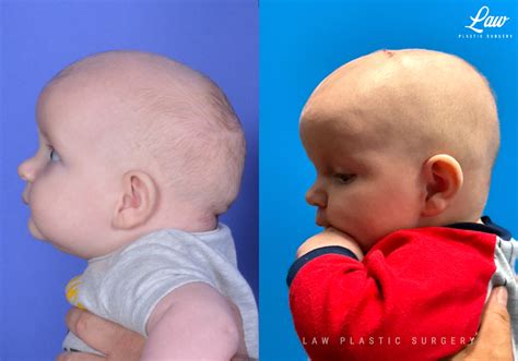 Craniosynostosis Before & After Photos - Sage Plastic Surgery