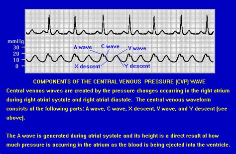 Central Venous Pressure Graph - Jessica Mackay