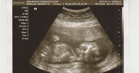 OUR INFERTILITY BATTLE: My Congenital Anomaly Scan (C.A.S)