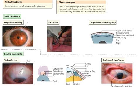 Glaucoma Symptoms, Signs, Causes, Risk factors, Stages, Diagnosis and Treatment - Jotscroll